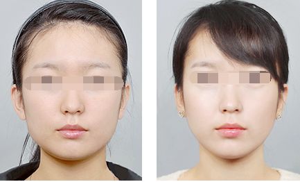 打完瘦脸针脸会肿吗?